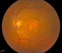 Supplements slow disease progression during late stage of “dry” age-related macular degeneration