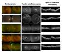 Scientists discover gene responsible for rare, inherited eye disease