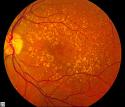 New research offers hope for preventing age-related blindness