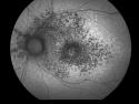 Researchers seek new treatment for blinding diseases AMD and Stargardt